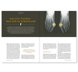 HALLUX VALGUS